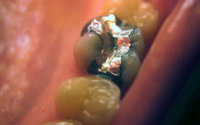 Can Fillings Affect Your Holistic Health?