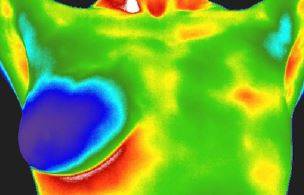How Thermography Can Help Monitor Mastectomy Surgeries